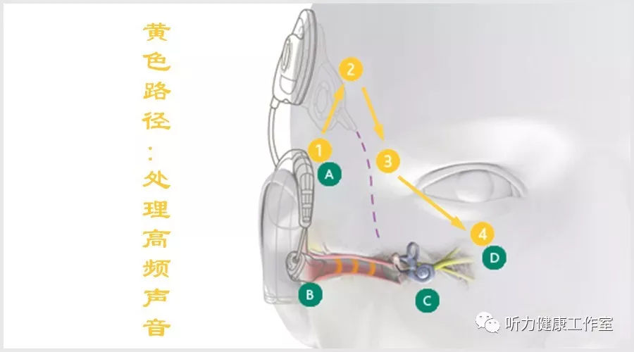 人工耳蜗