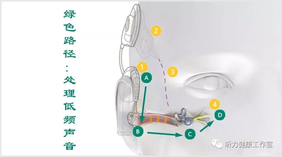 人工耳蜗