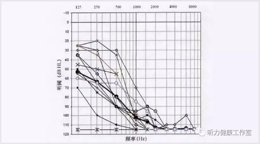 人工耳蜗